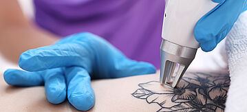 Tattooentfernung mit Laser